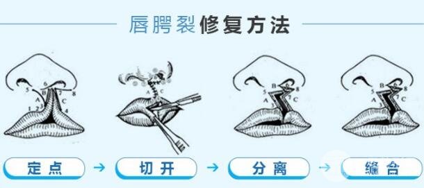 科普：兔唇手術(shù)多少錢？