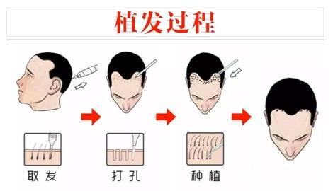 植發(fā)手術(shù)原理解析