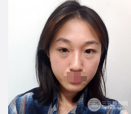 超聲法去眼袋手術(shù)怎么做