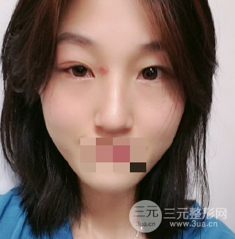 超聲法去眼袋手術(shù)怎么做