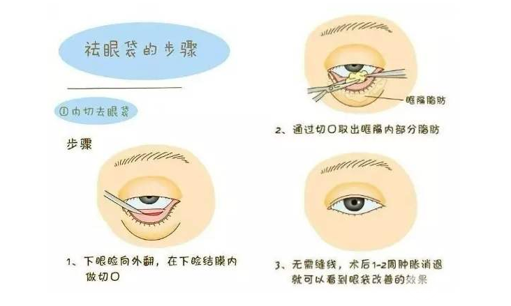 醫(yī)生建議做外切去眼袋的原因！眼下脂肪太多就適合做這個