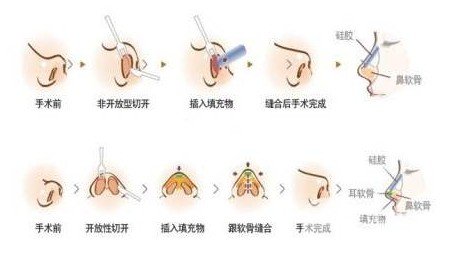 蒜頭鼻整形風(fēng)險(xiǎn)大嗎