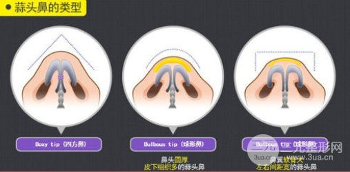 蒜頭鼻整形風(fēng)險(xiǎn)大嗎