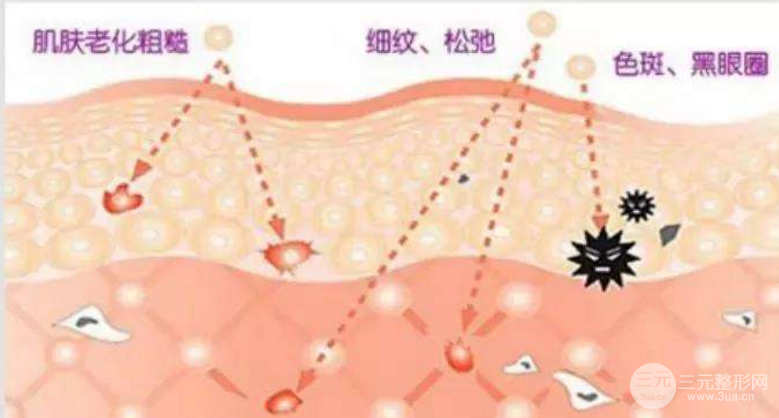 光子嫩膚緩解酒糟鼻
