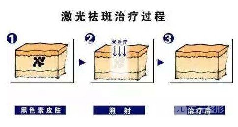 怎樣去黃褐斑