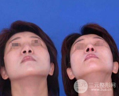 哪種隆鼻術(shù)好