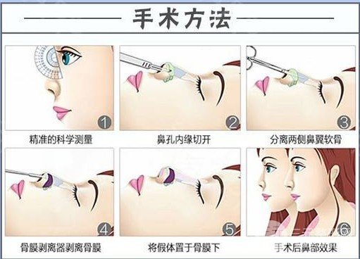 哪種隆鼻術(shù)好