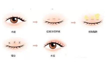 微創(chuàng)雙眼皮手術多久恢復