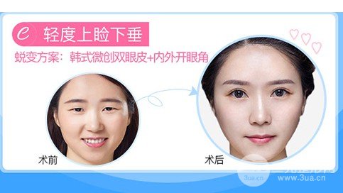 微創(chuàng)雙眼皮手術多久恢復