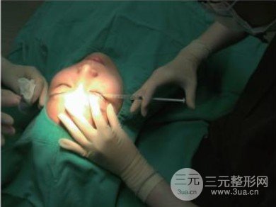 微創(chuàng)雙眼皮手術多久恢復