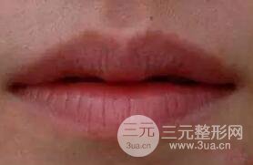 M唇手術(shù)步驟：