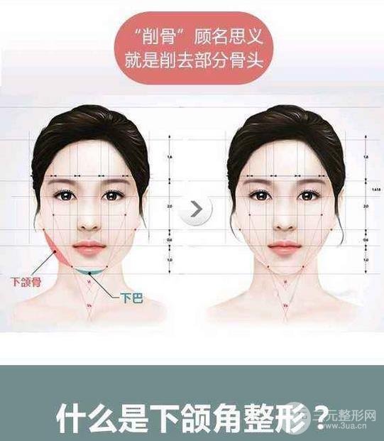國字臉削骨價(jià)格一般多少錢？手術(shù)注意事項(xiàng)以及案例圖分享~