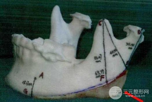 國字臉削骨價(jià)格一般多少錢？手術(shù)注意事項(xiàng)以及案例圖分享~