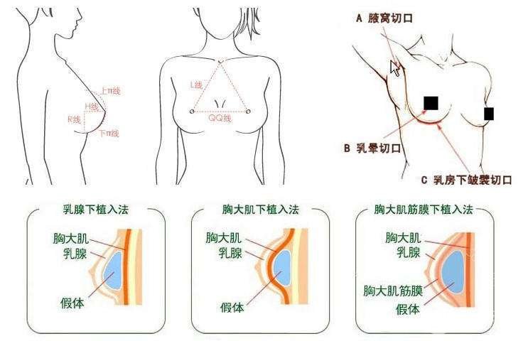 c罩杯多大胸圖片欣賞丨胸部整形手術(shù)之后需要注意什么？