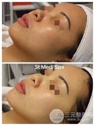 激光美白的價(jià)格