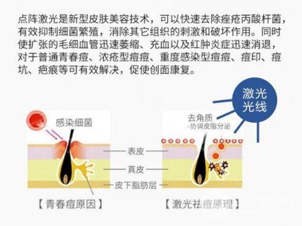 激光去痘印價格多少