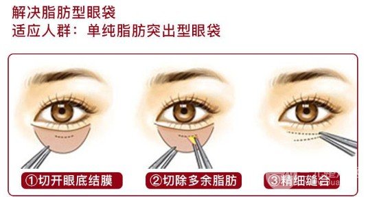 眼袋切除術(shù)需要多少錢