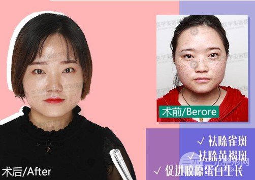 蜂巢激光祛斑恢復(fù)