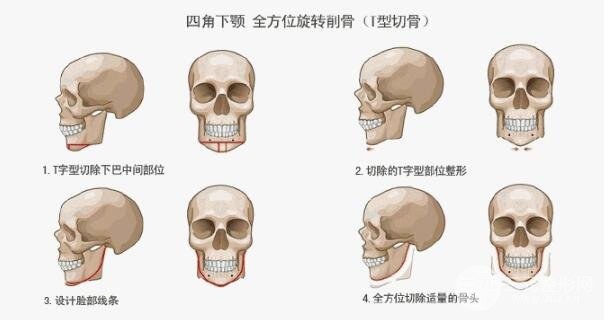 想做下頜角手術，磨頭還是削骨更好?