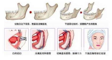 下頜角磨骨手術(shù)操作流程