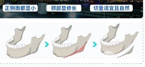 下頜角磨骨手術(shù)操作流程