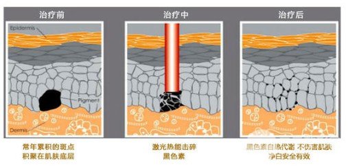 激光祛黃褐斑幾次能看到果
