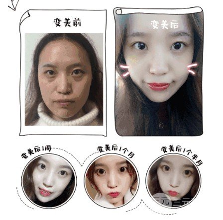 吸脂去眼袋多久能恢復(fù)