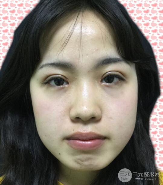 耳軟骨墊鼻尖失敗照片|鼻修復(fù)經(jīng)歷，鼻子第二次重生~