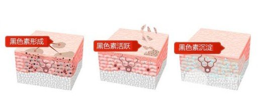 激光美白多少錢