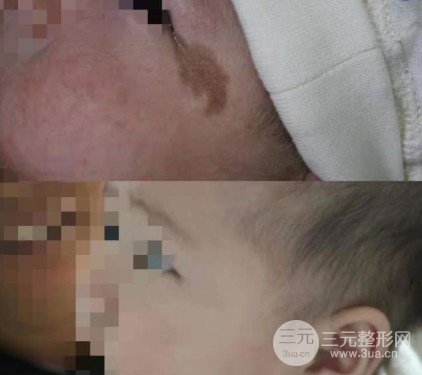 如何去掉胎記