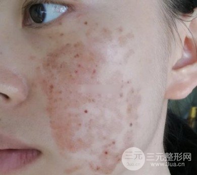 如何去掉胎記