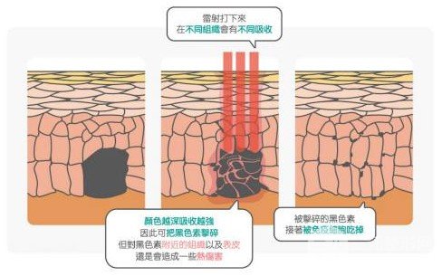 激光嫩膚美白多少錢