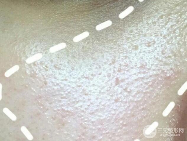 脂肪粒的自白：停用眼霜真的有用嗎？