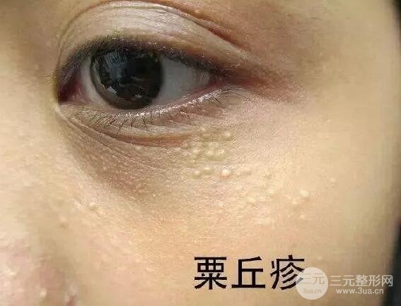 脂肪粒真的是因為護膚品過剩導致的嗎?