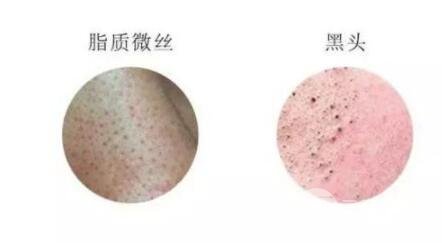 頑固黑頭：黑頭心中刺，拔掉萬般難！