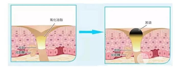 頑固黑頭：黑頭心中刺，拔掉萬般難！