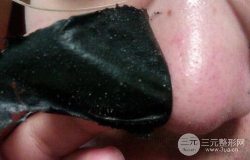 頑固黑頭：黑頭心中刺，拔掉萬般難！