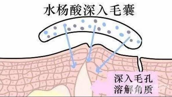 頑固黑頭：黑頭心中刺，拔掉萬般難！