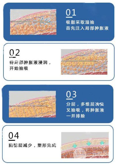 下巴吸脂多少錢