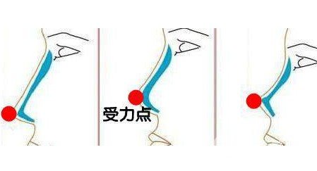 硅膠隆鼻整形手術(shù)
