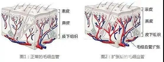 毛細血管擴張