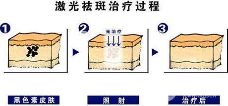 激光祛斑緩解過程圖