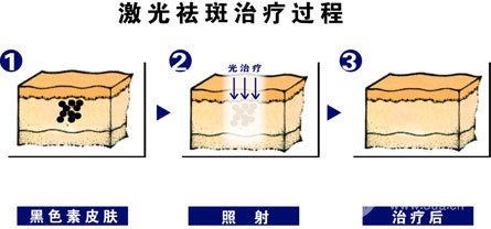 激光祛斑術(shù)后護(hù)理