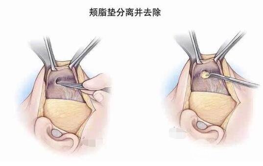 什么是頰脂墊?