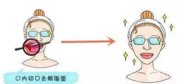 在去除頰脂墊手術(shù)后，會不會有臉頰凹陷?