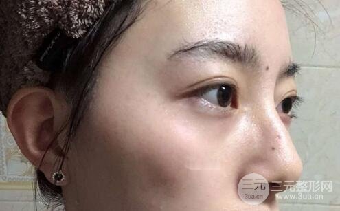 蜂巢激光祛斑案例術(shù)后4個月