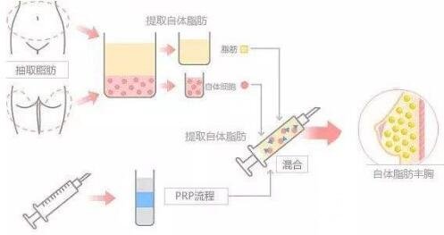 上海九院隆胸大概多少錢(qián)?幾有做呢?
