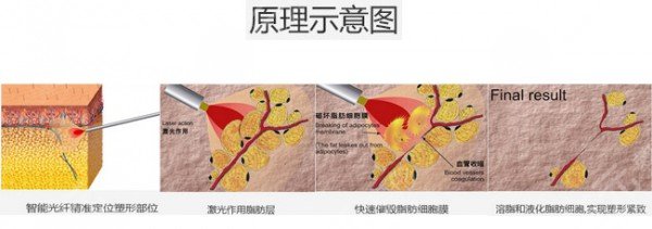 光纖溶脂瘦臉多久恢復(fù)