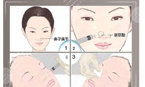 注射隆鼻后如何護(hù)理?