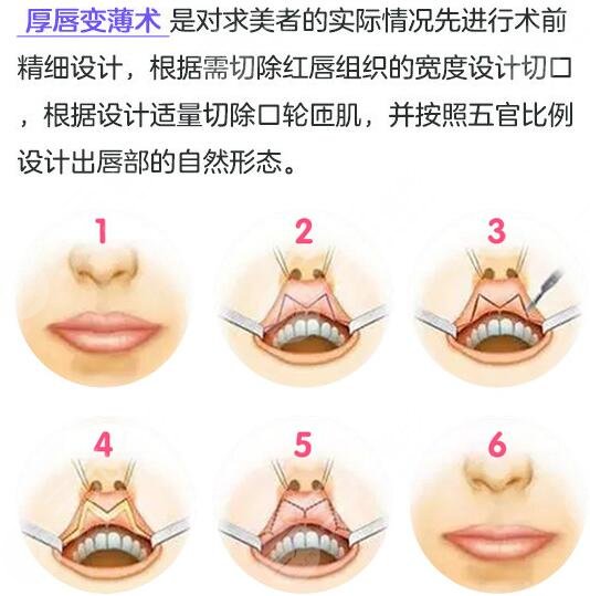 厚唇改薄手術降低風險嗎